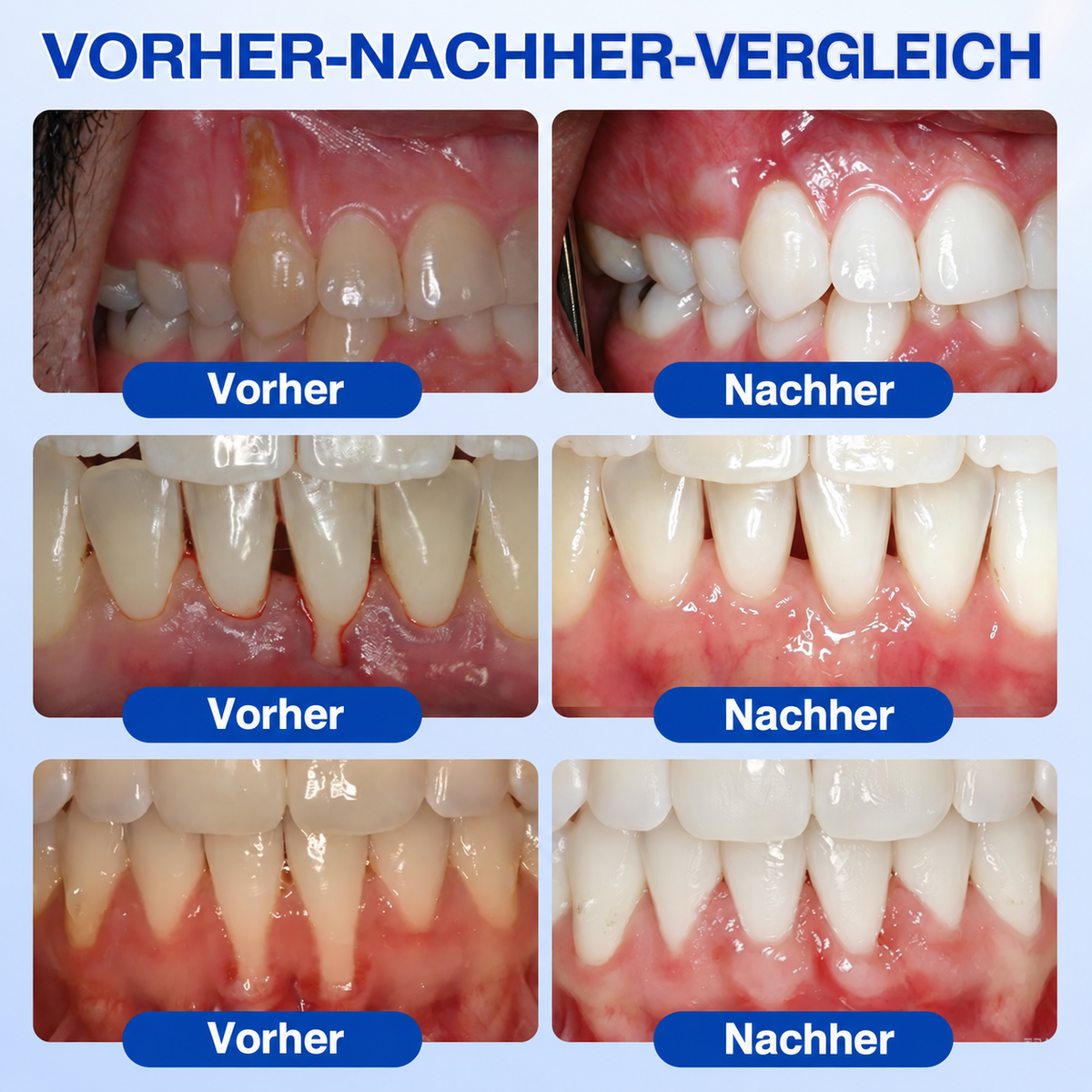 🏅🦷📌 Vivanoura® Zahnfleisch-Regenerationsgel für Parodontitis