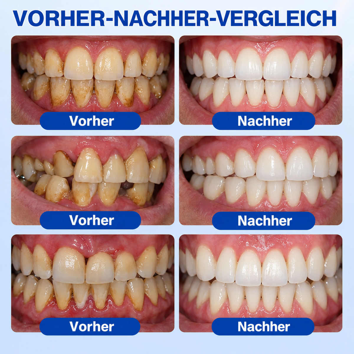 🏅🦷📌 Vivanoura® Zahnfleisch-Regenerationsgel für Parodontitis