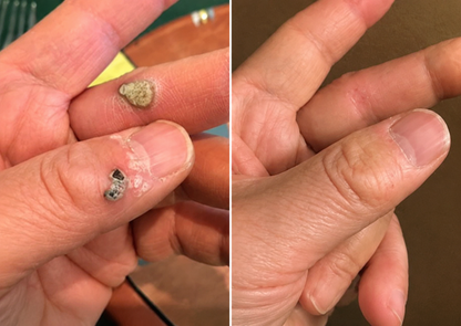 🔥 CVS®2-in-1 Microneedle & Hydrocolloid Patch🔥| Removes Raised Moles, Acne, Flat Warts & Skin Tags | Helps Improve Wrinkles, Scars & Blemishes | Invisible Patches for Face & Body